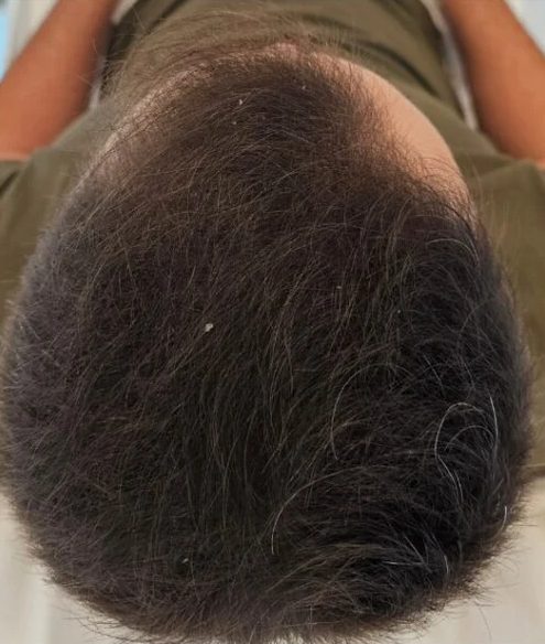 DR Jasonek ReGrow Protocol: po 9 miesiącach