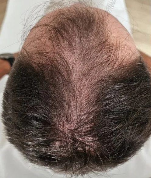 DR Jasonek ReGrow Protocol: przed leczeniem