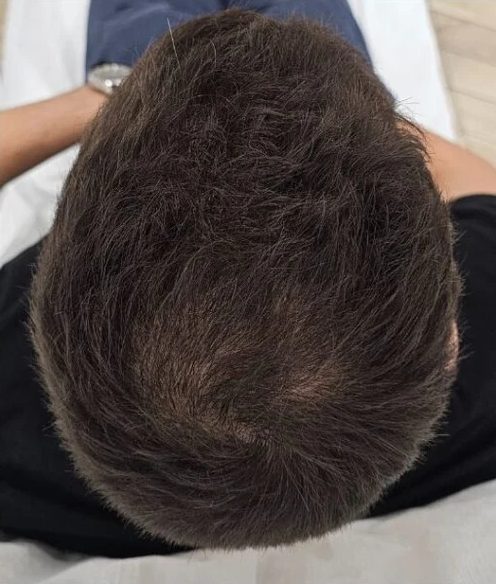Nowy protokół leczenia: po 1 miesiącu