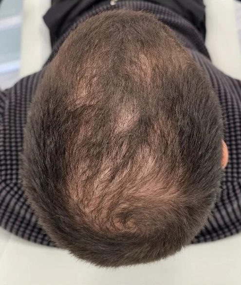 Nowy protokół leczenia: przed leczeniem